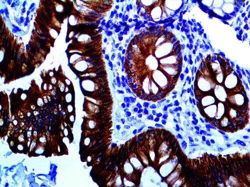 IHC of HER-3 on an FFPE Colon Tissue
